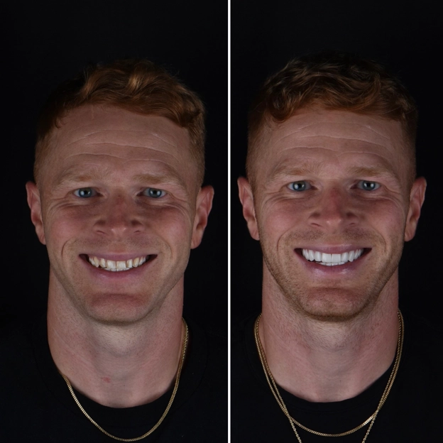 Veneer case before and after