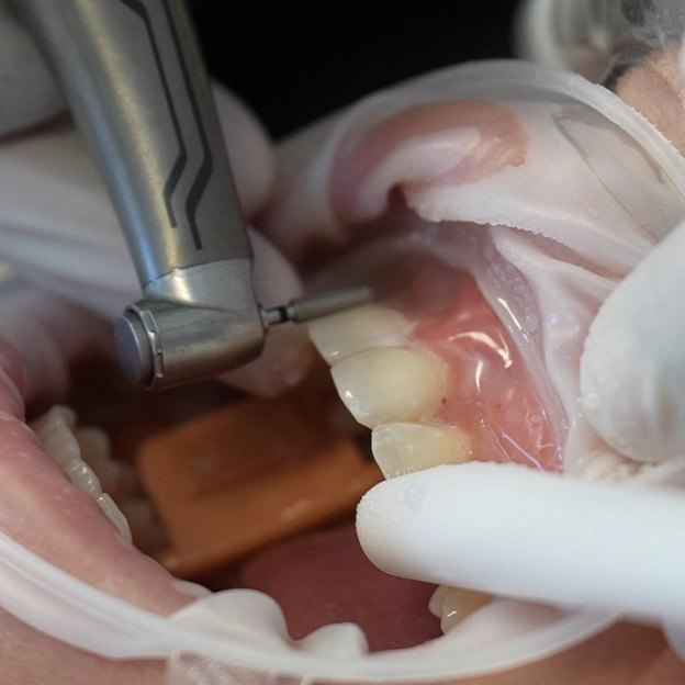 Handpiece reducing an anterior tooth during veneer preparation, with the lip retracted and the margin visible at the gingival third