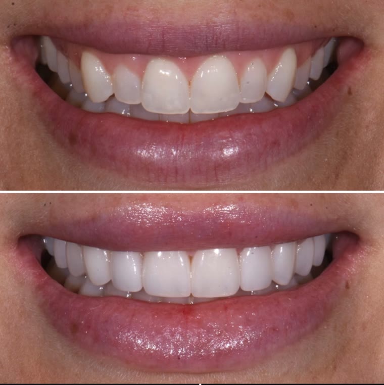 Before and after photographs of a porcelain veneer case, showing the standardized documentation series a cosmetic dentist builds for every patient