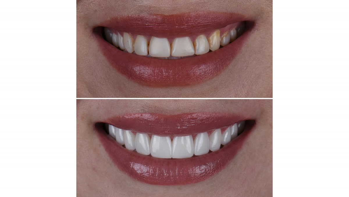 Before and after porcelain veneer case